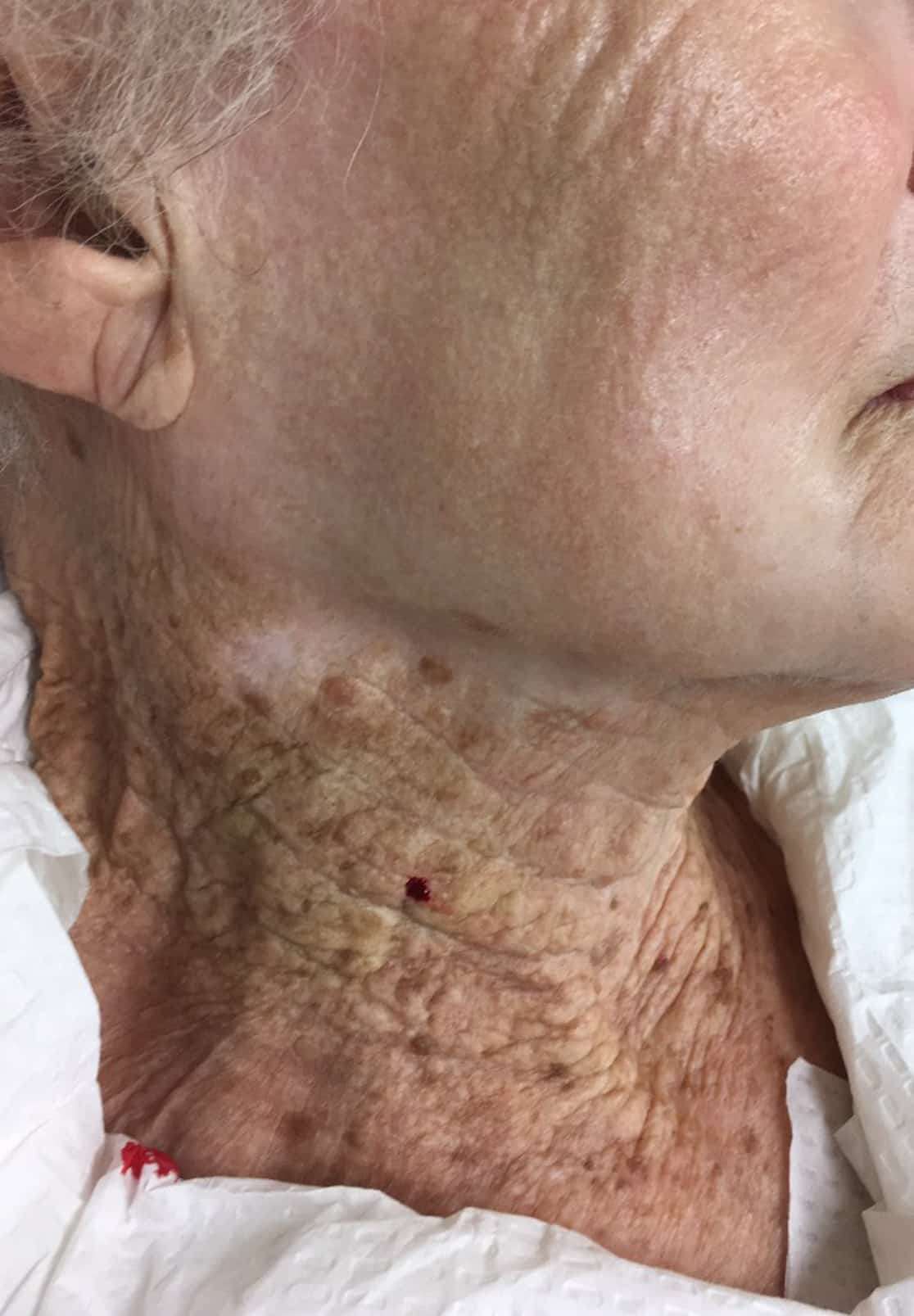 Skin cancer: An image of an elderly woman who only used sunscreen for decades spreads across her face