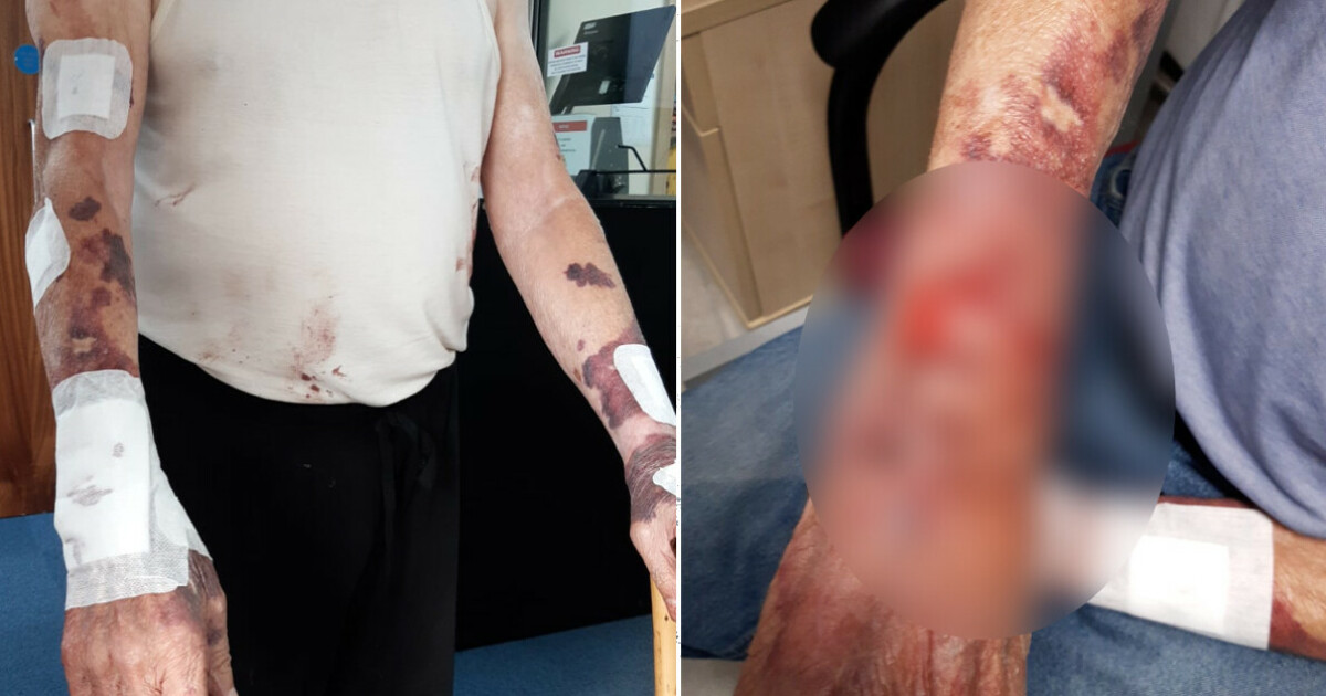 Grandfather (81) is covered in blood and bruises